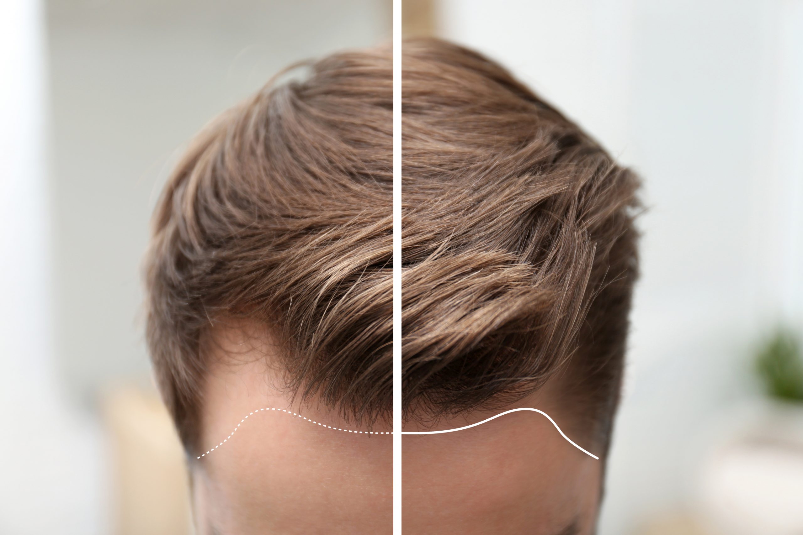 ¿Cómo afecta la creatina al pelo?